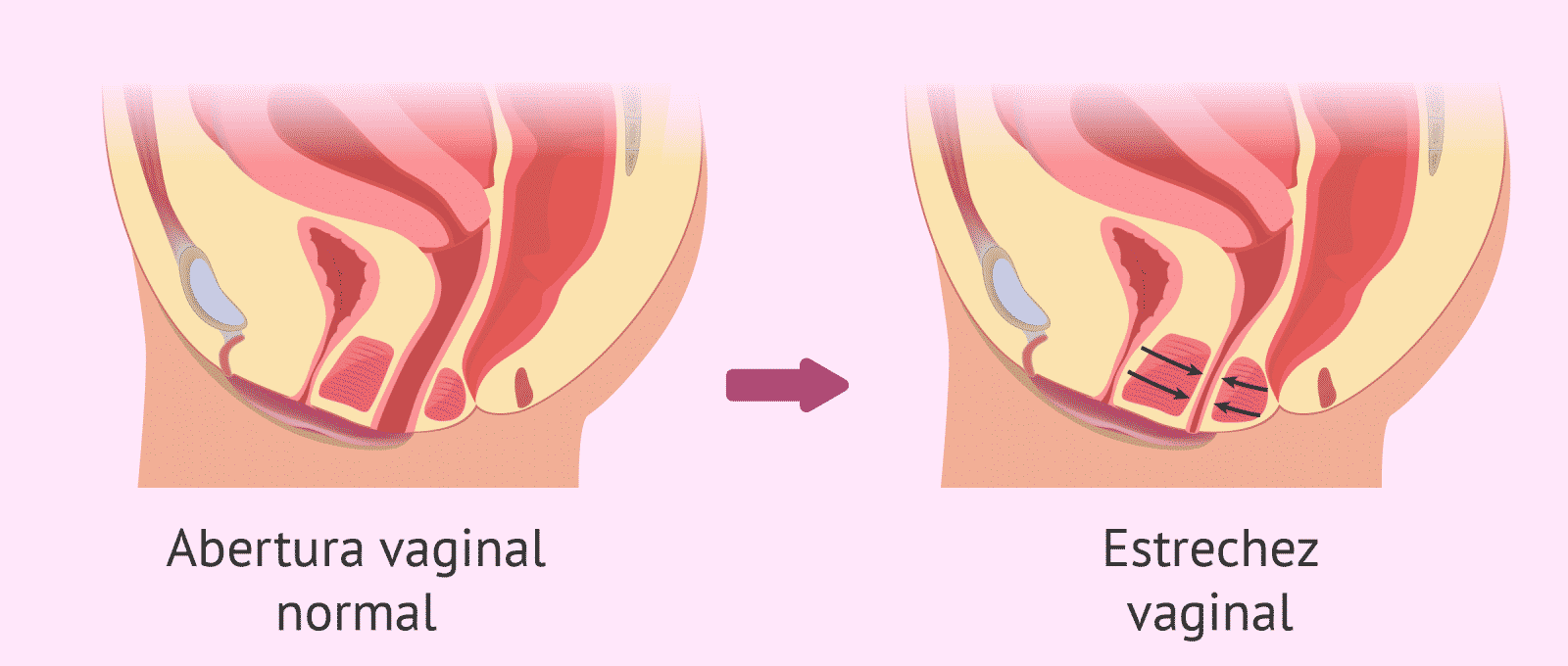 Vaginismus Causes Of Vaginal Narrowing Sileu Cup Menstrual Cup And