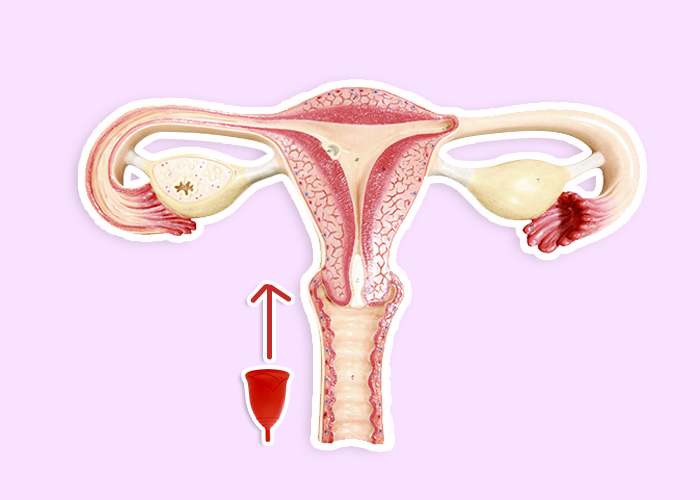 Copa menstrual y cérvix alto