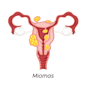 miomas y flujo menstrual abundante